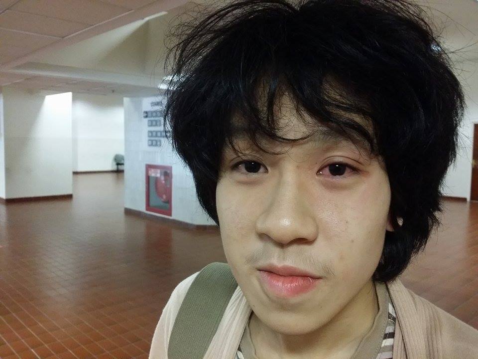 Amos Yee's eye swollen and red after the assault. (Image by Roy Ngerng)
